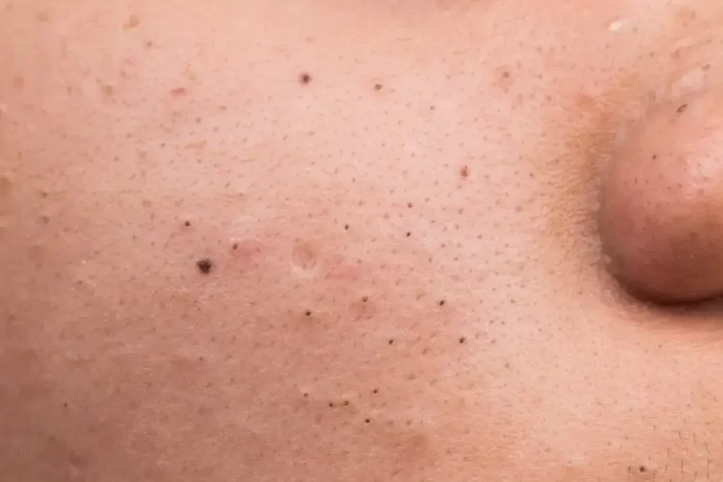 How to Get Rid of Blackheads