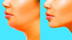 How to Get Rid of Chubby Cheeks – Fast and Easy