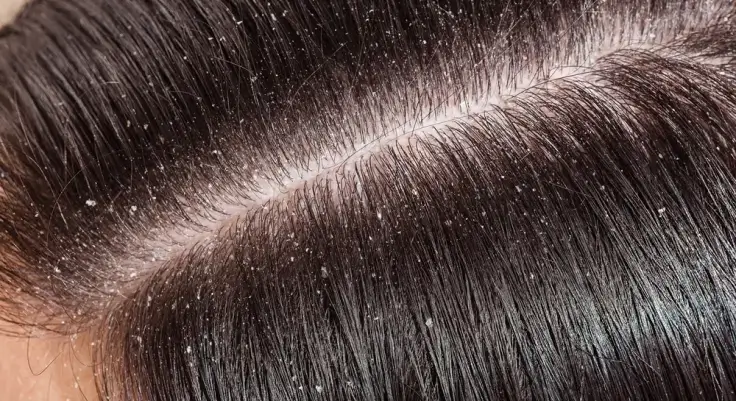 Natural Remedies to Get Rid of Dandruff