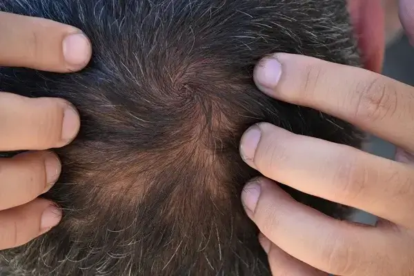 Signs of Balding for Permanent Hair Loss