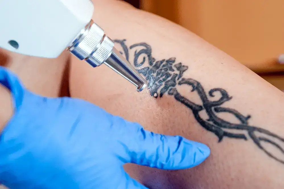 The Ultimate Guide to Tattoo Removal & Nonsurgical Treatments