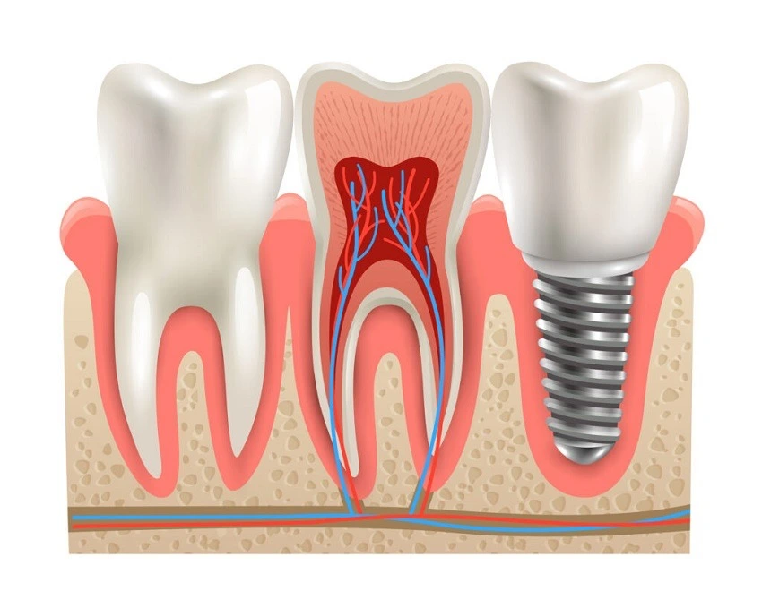 5 Simple Way To Improve Your Health With Dental Implants