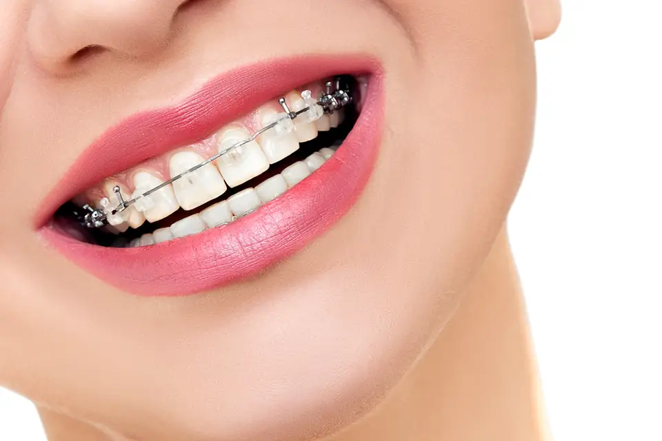 Invisible Braces Brands in India