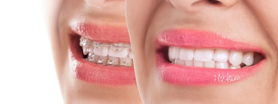 10 Myths About Invisible Braces You Should Stop Believing