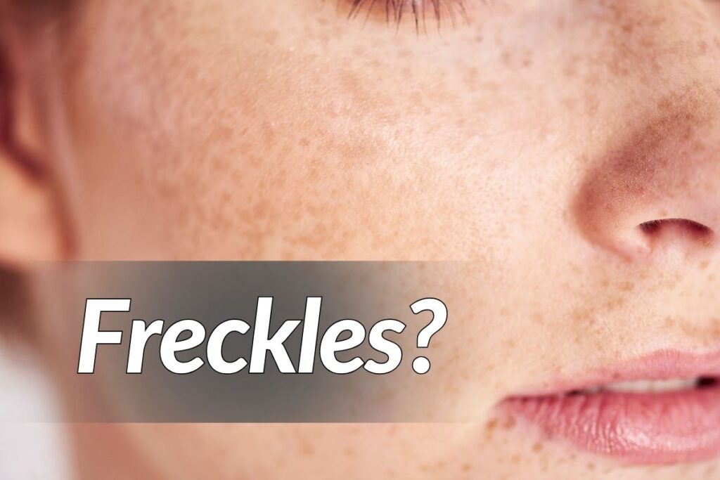 Freckles Skin Health: How Homeopathy Can Restore Your Glow