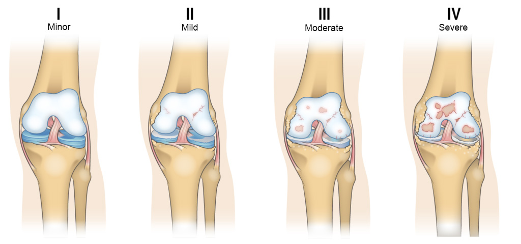 How Can Knee Bracing Relieve Osteoarthritis Pain?