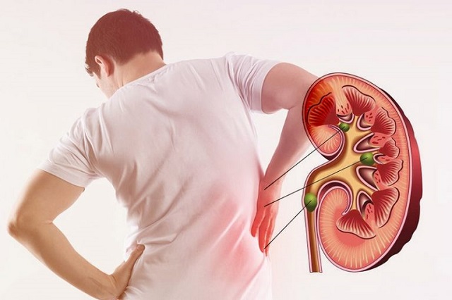 Kidney Stone Treatment in Ahmedabad