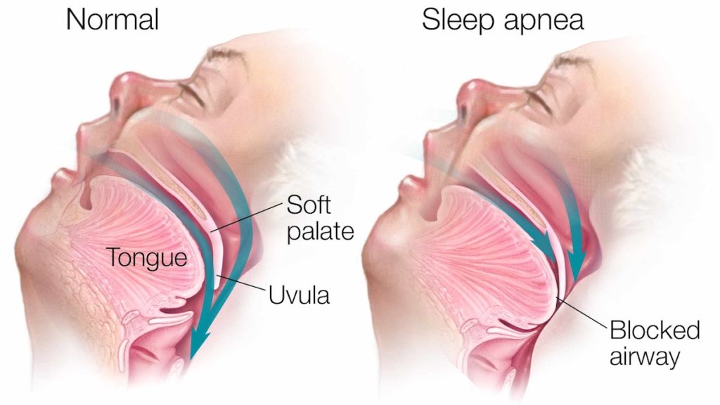 10 The Most Common Signs and Symptoms of Sleep Apnea