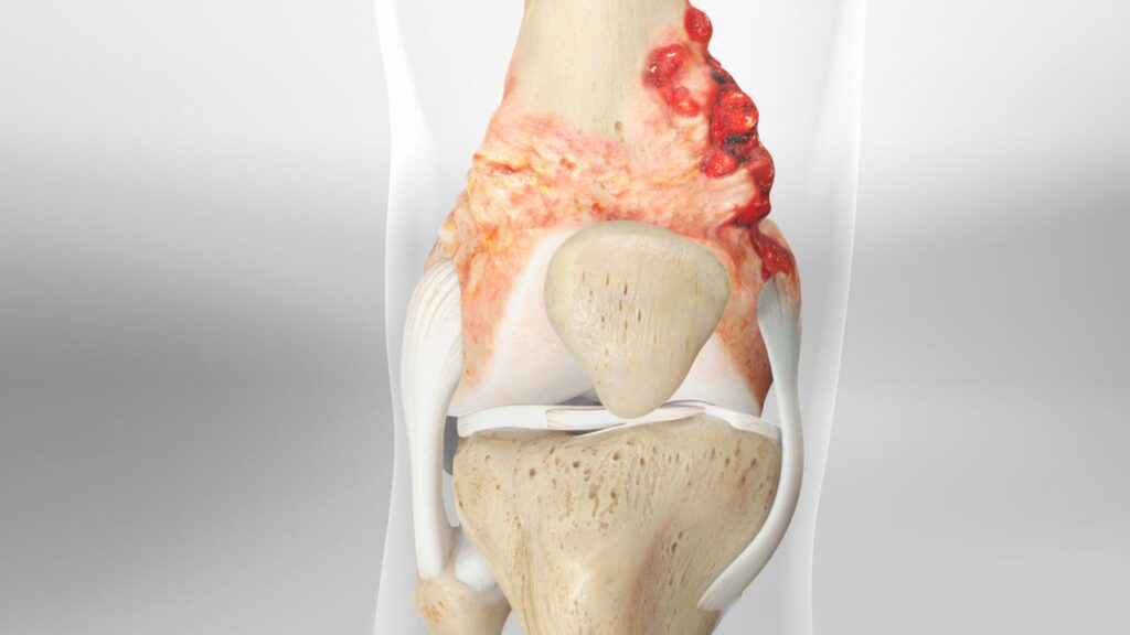 What Are the Causes, Symptoms and Treatment of Ortho Cancer