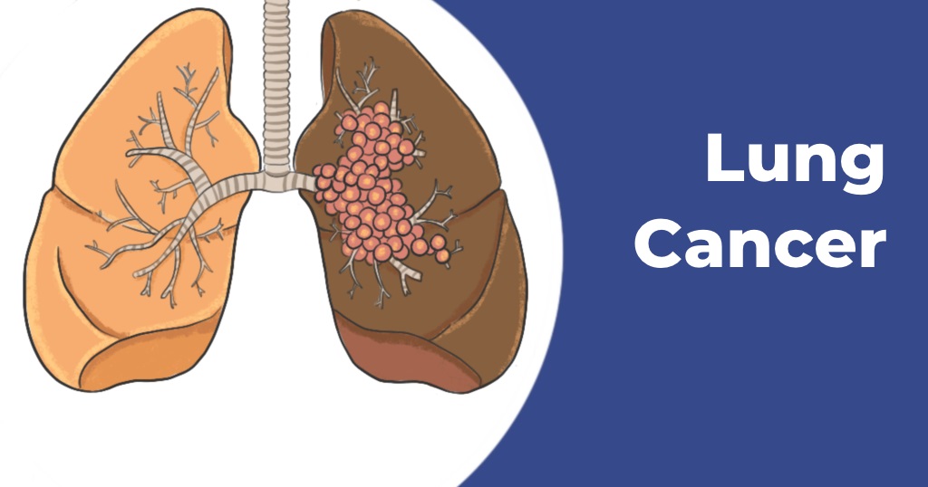 What Are the Habits to Lower Lung Cancer Risk
