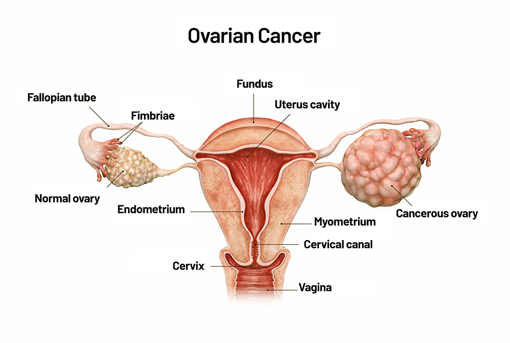 What Are the Natural Ways to Reduce Ovarian Cancer Risk