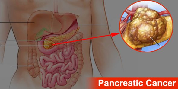 Why Does Early Detection Matter in Pancreatic Cancer